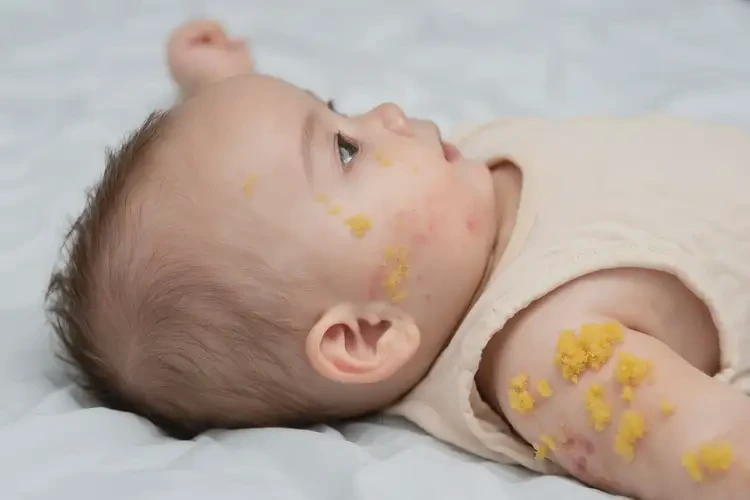幼兒手臂上偶爾起濕疹可不可以徹底自愈(圖2)