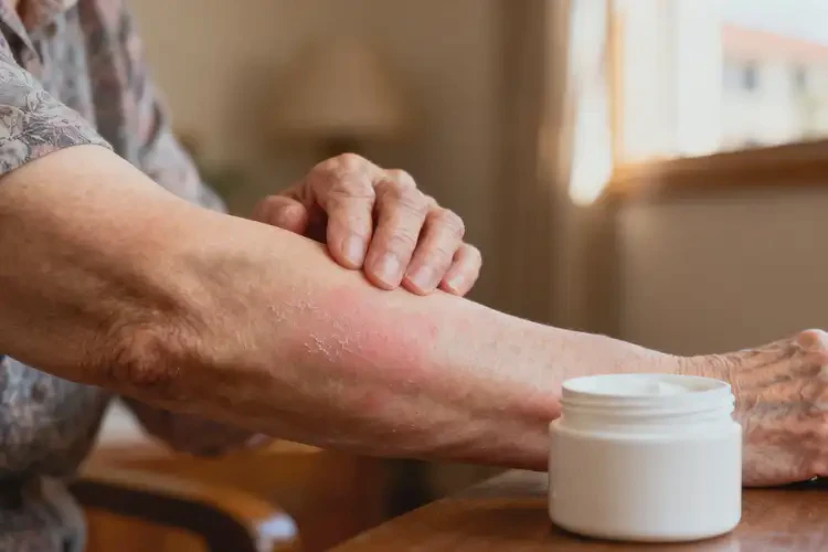 高齡老人身上經(jīng)常起濕疹不管它會(huì)自己好嗎(圖3)