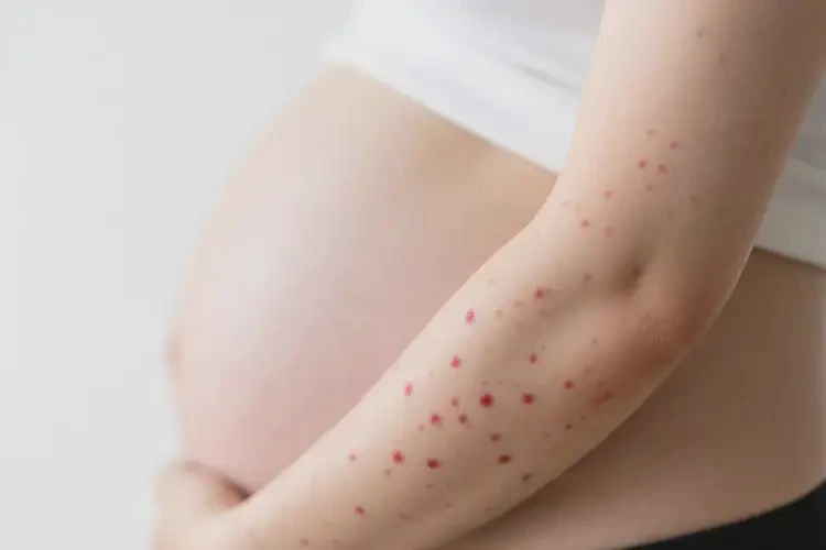 孕妇手臂上容易长湿疹能彻底自愈吗(图1)