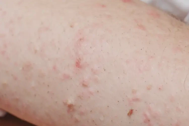 小孩手臂上有濕疹可以徹底自愈嗎(圖4)