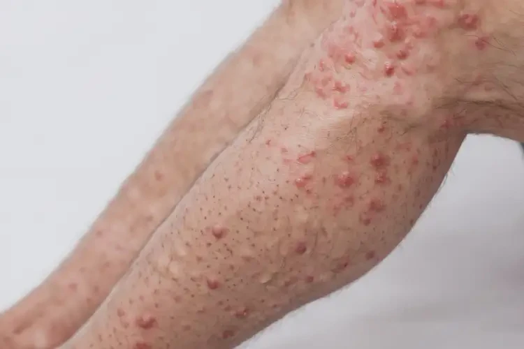 男人四肢容易起濕疹不管它會自己痊愈嗎(圖4)