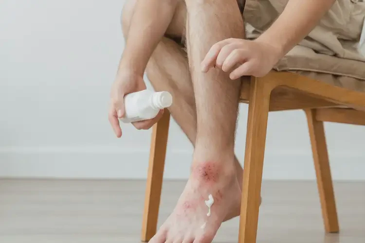 青少年腳上出濕疹可不可以徹底自愈(圖1)