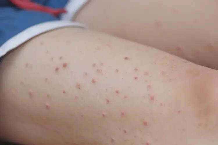 中學生大腿偶爾起濕疹能不能徹底自愈(圖3)