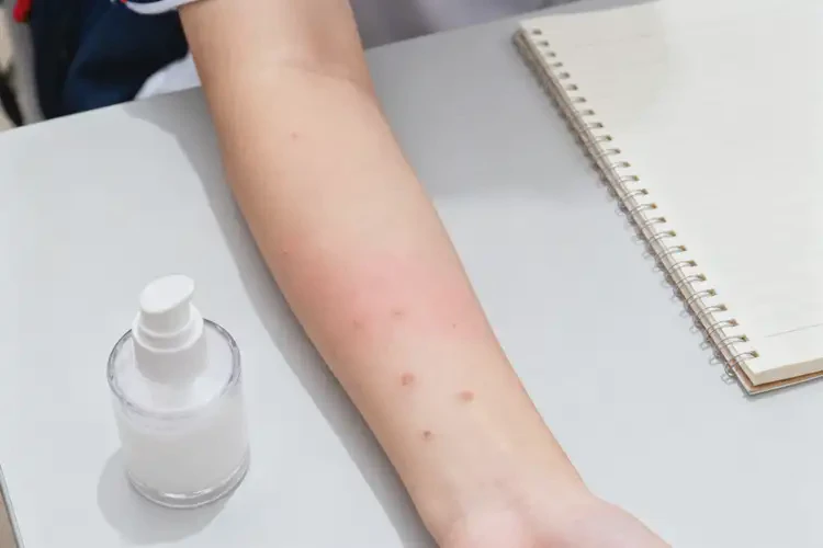 大學生手臂上經常起濕疹能夠徹底治愈嗎(圖3)
