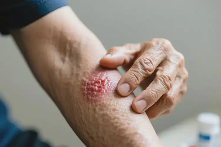 老年人手臂出現(xiàn)濕疹不管它會(huì)自己痊愈嗎(圖3)