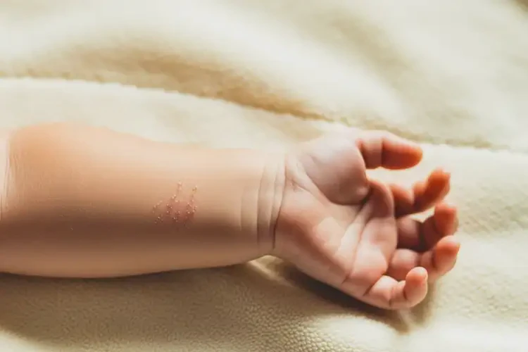 幼儿手臂上偶尔起湿疹能靠自己自愈吗(图3)