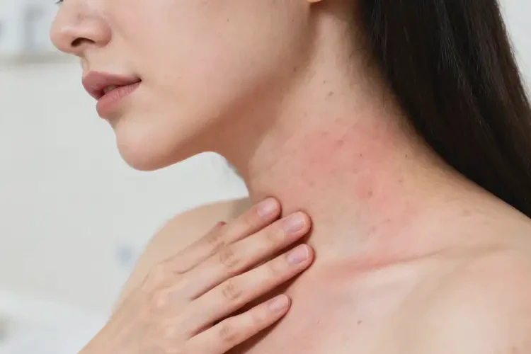 孕婦脖子上經(jīng)常起濕疹能靠自己自愈嗎(圖2)