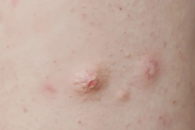 青少年全身偶爾起濕疹能靠自己自愈嗎(圖4)