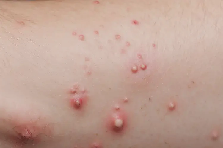 青少年手臂經(jīng)常起濕疹能徹底自愈嗎(圖4)