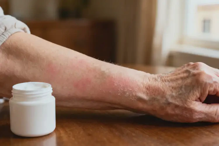 高齡老人身上經(jīng)常起濕疹不管它會(huì)自己好嗎(圖1)