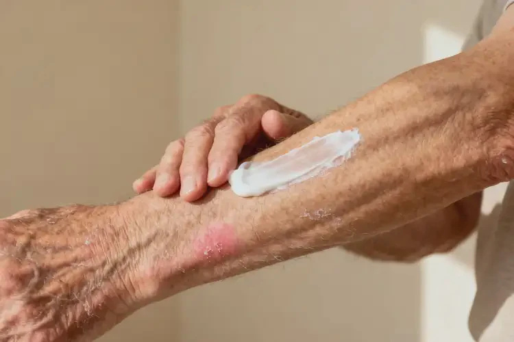 老年人手臂經(jīng)常起濕疹可以徹底自愈嗎(圖1)