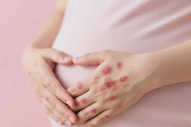 產(chǎn)婦手上經(jīng)常起濕疹不管它會自己自愈嗎(圖1)