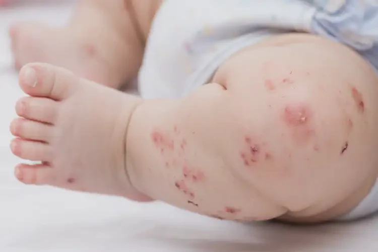 宝宝小腿偶尔起湿疹可不可以彻底自愈(图3)