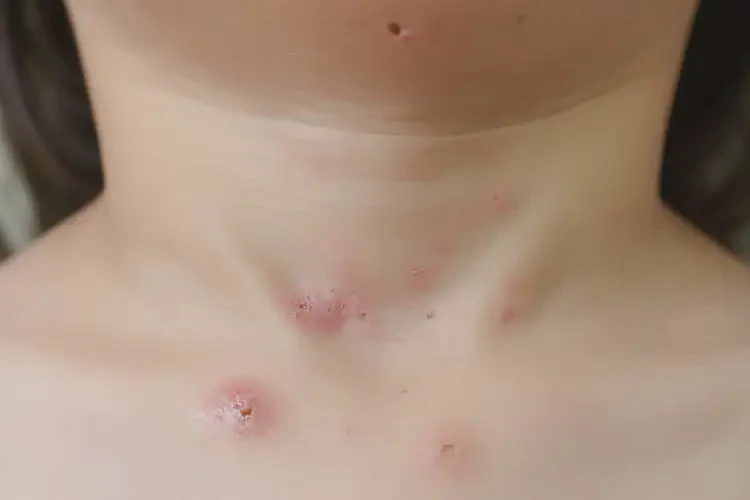 孩子脖子經(jīng)常起濕疹不管它會(huì)自己痊愈嗎(圖4)