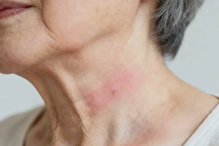 老人脖子上經(jīng)常長(zhǎng)濕疹能靠自己自愈嗎(圖2)