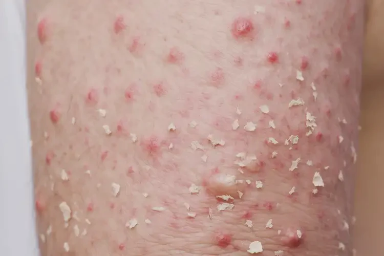 大学生脚上偶尔长湿疹不管它会自己痊愈吗(图3)