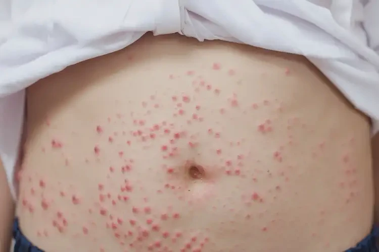 中學(xué)生肚子偶爾起濕疹能徹底自愈嗎(圖4)