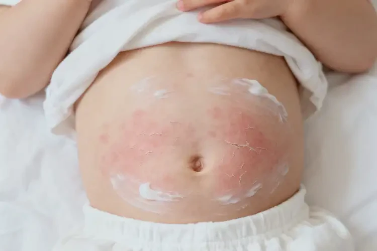兒童肚子長濕疹能徹底自愈嗎(圖1)