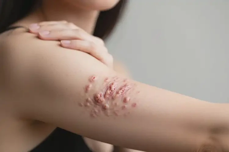 女人手臂出濕疹能不能徹底自愈(圖1)