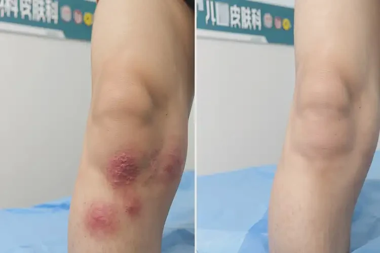 小兒大腿長濕疹不管它會自己好嗎(圖1)