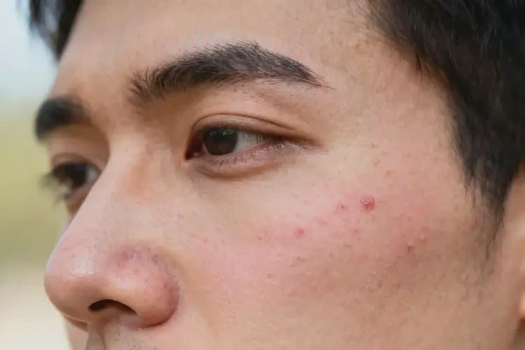 男人臉上偶爾長濕疹不管它會自己自愈嗎(圖2)