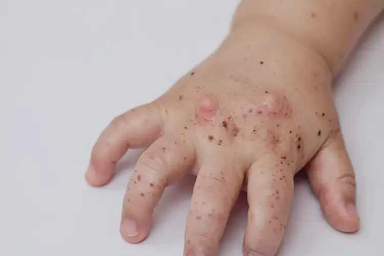 幼兒手上經(jīng)常起濕疹可不可以徹底自愈(圖4)