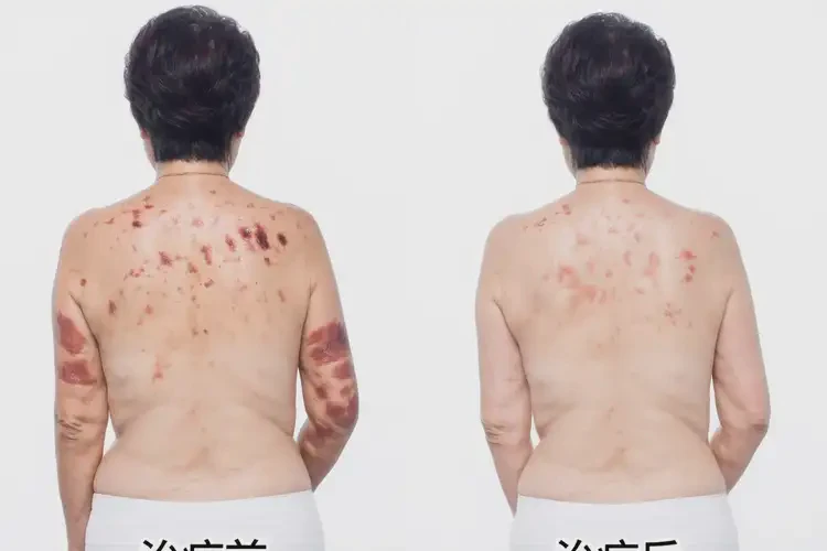 女性全身容易起濕疹能徹底自愈嗎(圖2)