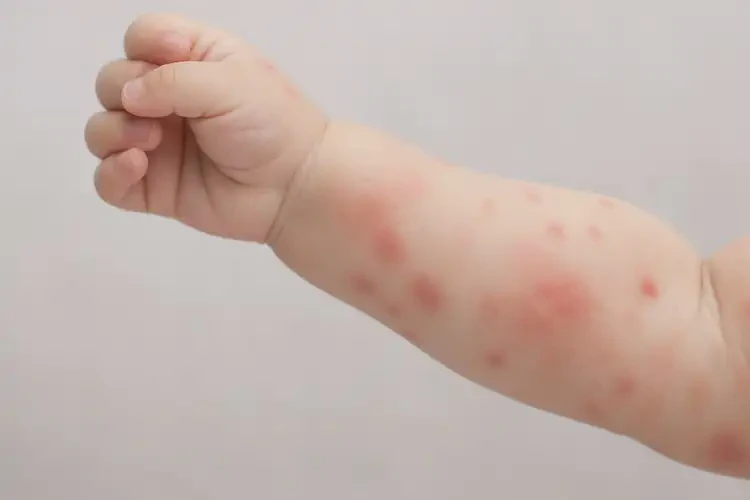 幼兒手臂上偶爾起濕疹可不可以徹底自愈(圖1)
