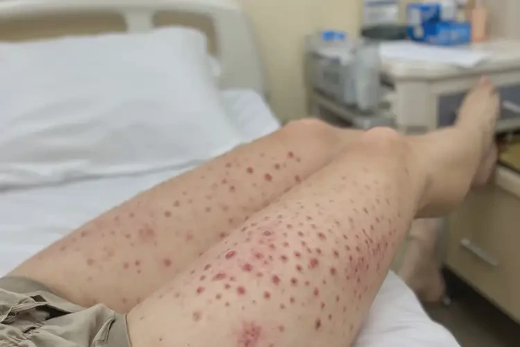 產(chǎn)婦大腿經(jīng)常起濕疹能夠徹底治愈嗎(圖4)