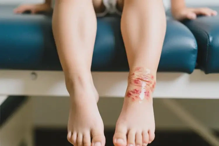 兒童腳上經(jīng)常長(zhǎng)濕疹能夠徹底治愈嗎(圖2)