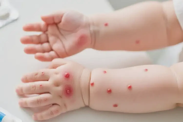 嬰兒手臂偶爾起濕疹能靠自己自愈嗎(圖1)