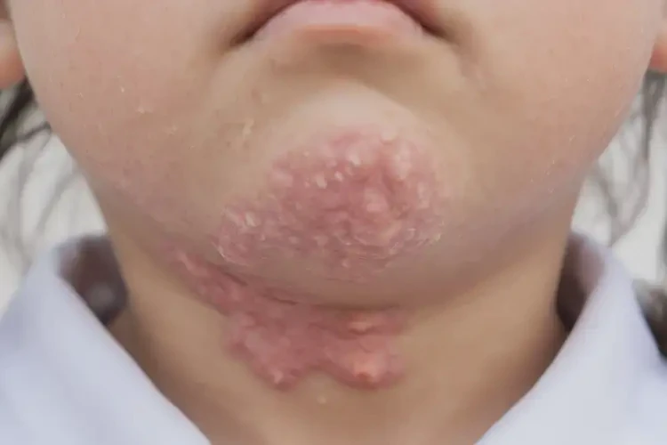 小學(xué)生脖子經(jīng)常起濕疹可不可以徹底自愈(圖4)