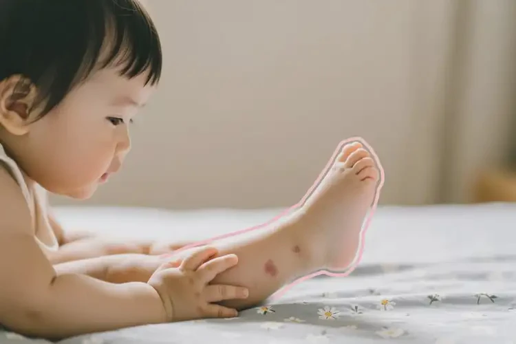 幼兒小腿上出現(xiàn)濕疹能夠徹底治愈嗎(圖3)