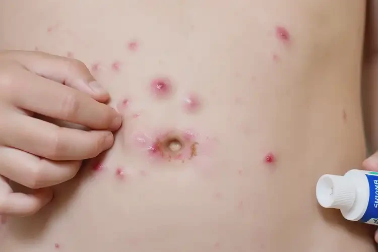 兒童肚子容易起濕疹不管它會自己痊愈嗎(圖3)