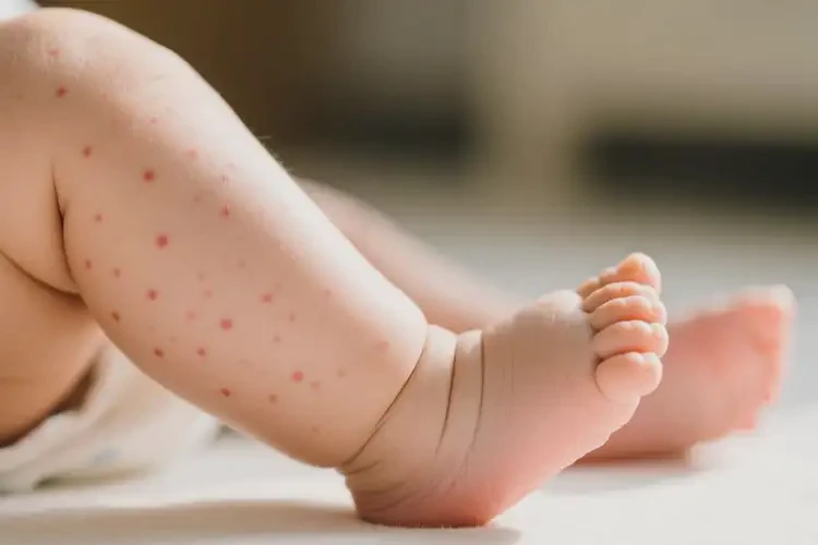 嬰幼兒小腿偶爾長濕疹不管它會自己自愈嗎(圖2)