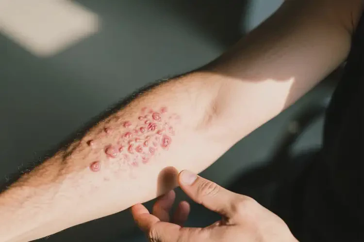 男人手臂有濕疹不管它會(huì)自己好嗎(圖1)