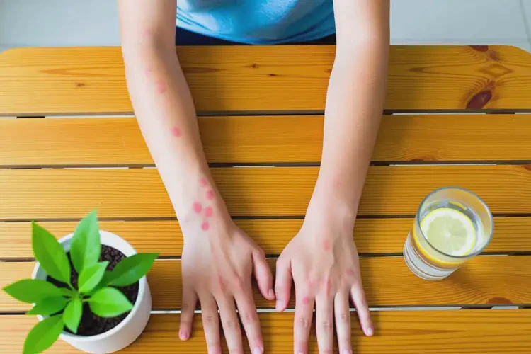 青少年手臂上出濕疹可不可以徹底自愈(圖3)