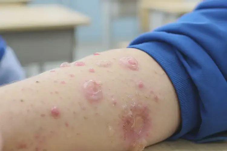 中學生手臂上長濕疹不管它會自己好嗎(圖4)