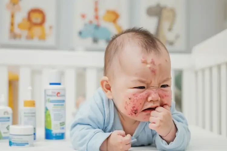 嬰兒臉上出濕疹不管它會自己好嗎(圖4)