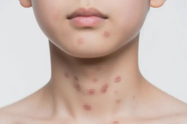 青年人脖子上偶尔长湿疹能彻底自愈吗(图3)