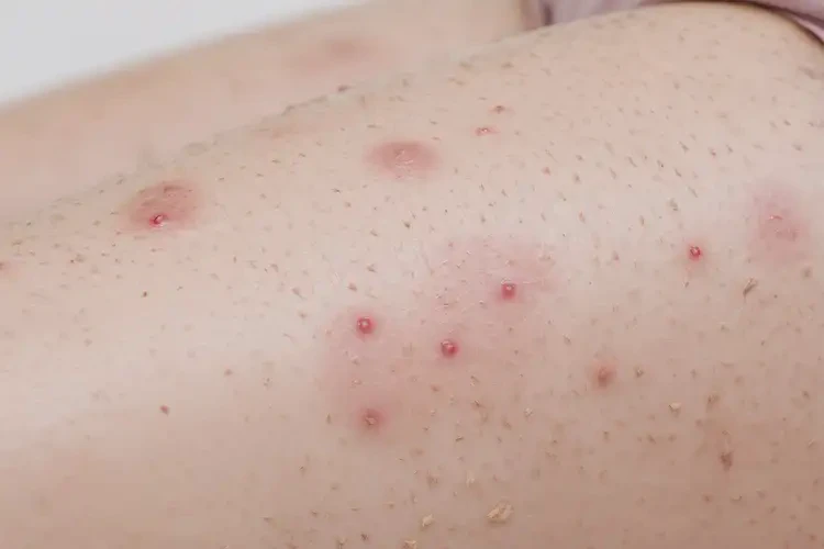 孕婦大腿上經(jīng)常長濕疹不管它會(huì)自己自愈嗎(圖3)