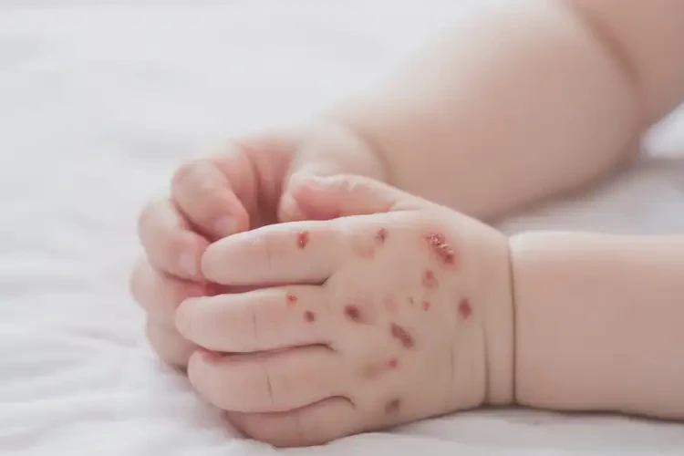 嬰幼兒手上容易起濕疹可不可以徹底自愈(圖1)