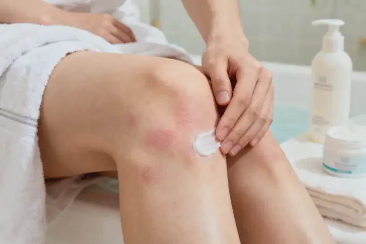 青年人大腿上出現(xiàn)濕疹能夠徹底治愈嗎(圖2)