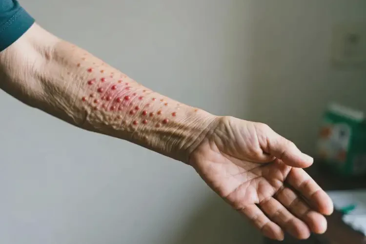 老年人手臂上起濕疹不管它會(huì)自己痊愈嗎(圖4)