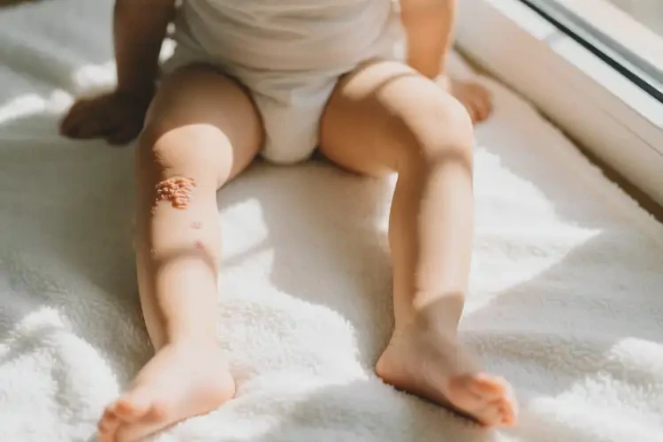 小兒大腿上容易起濕疹可以徹底自愈嗎(圖3)