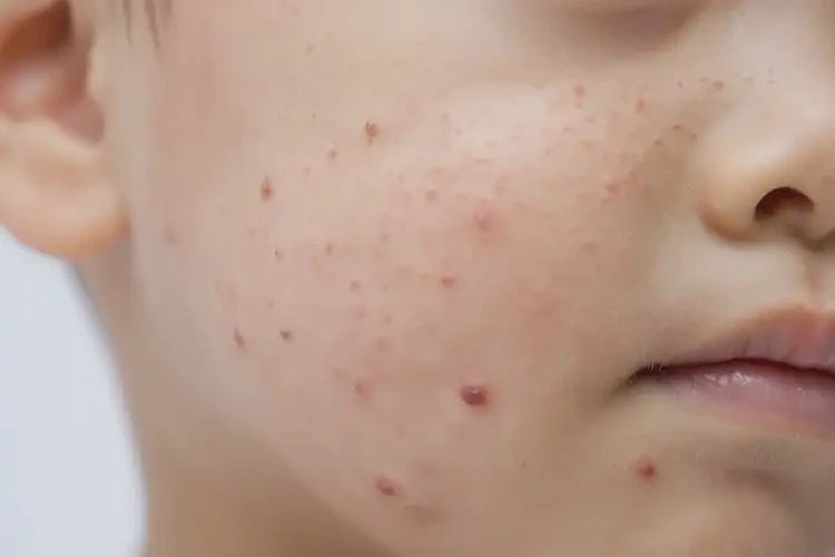 小学生脸上有湿疹不管它会自己好吗(图4)