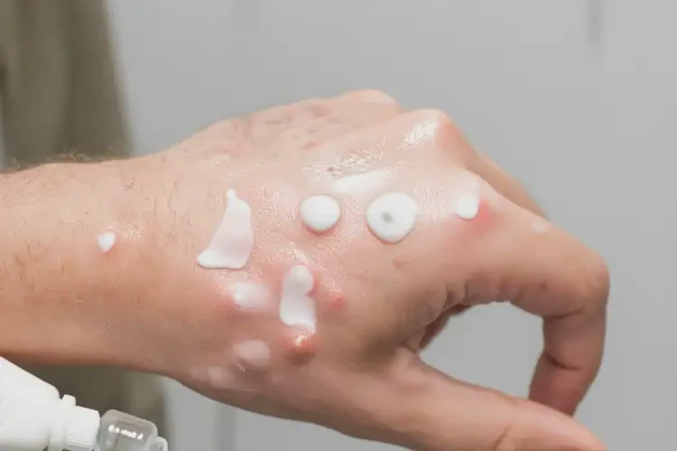 青年人四肢經(jīng)常起濕疹可以徹底自愈嗎(圖3)