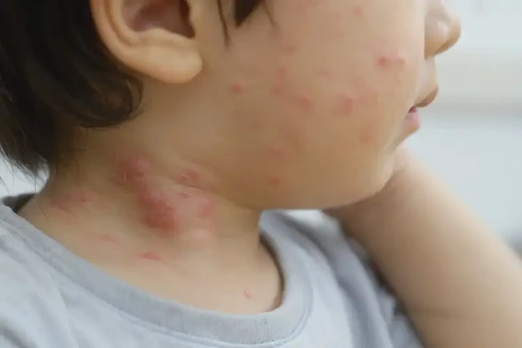 少儿脖子有湿疹不管它会自己自愈吗(图4)