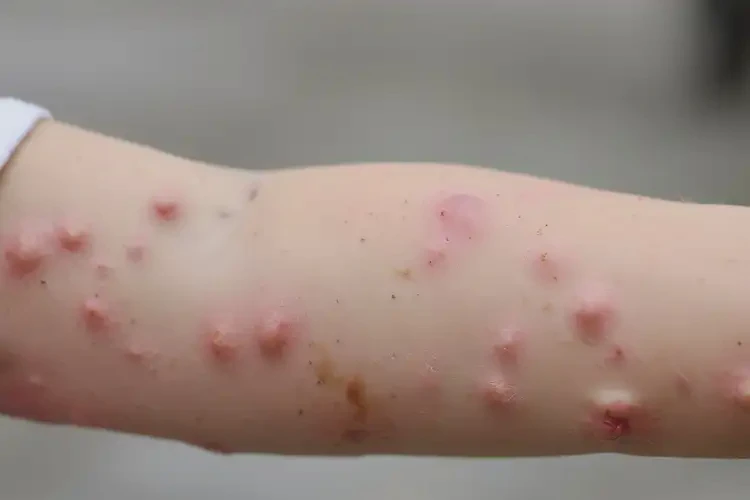 孩子手臂上出濕疹不管它會(huì)自己自愈嗎(圖4)