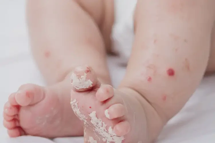 嬰兒腳上容易長濕疹可以徹底自愈嗎(圖4)